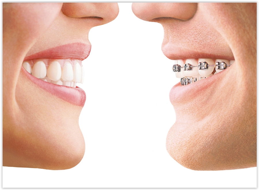 Invisalign