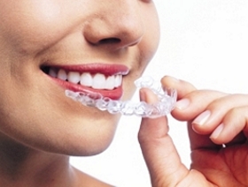 Invisalign invisible aligners