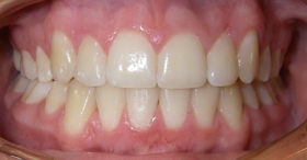 After orthodontic treatment