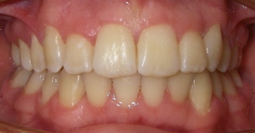 After orthodontic treatment