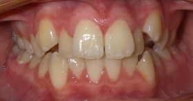 Before orthodontic treatment